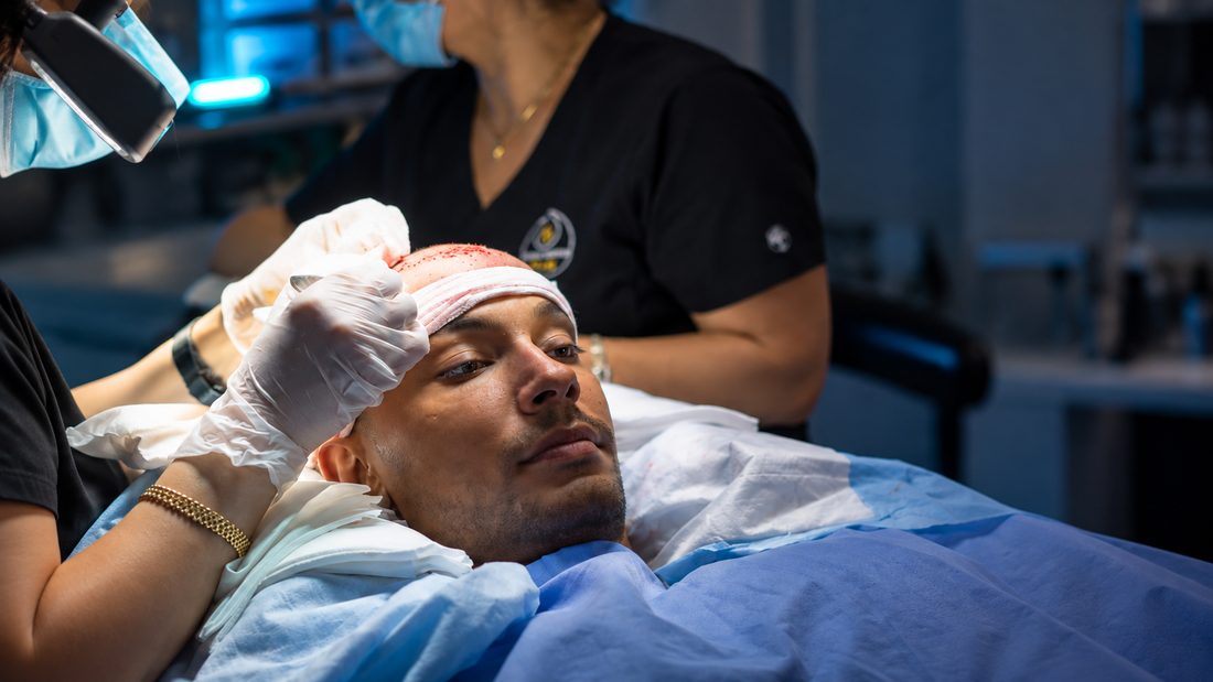 Technician placing grafts along a patient's hairline during a DHI hair transplant in Philadelphia