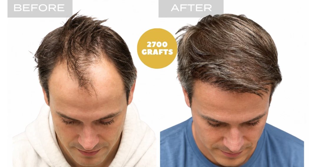 Before and after photo, Nova Medical Philadelphia: Receding hairline and frontal density restoration with 2,700 FUE grafts