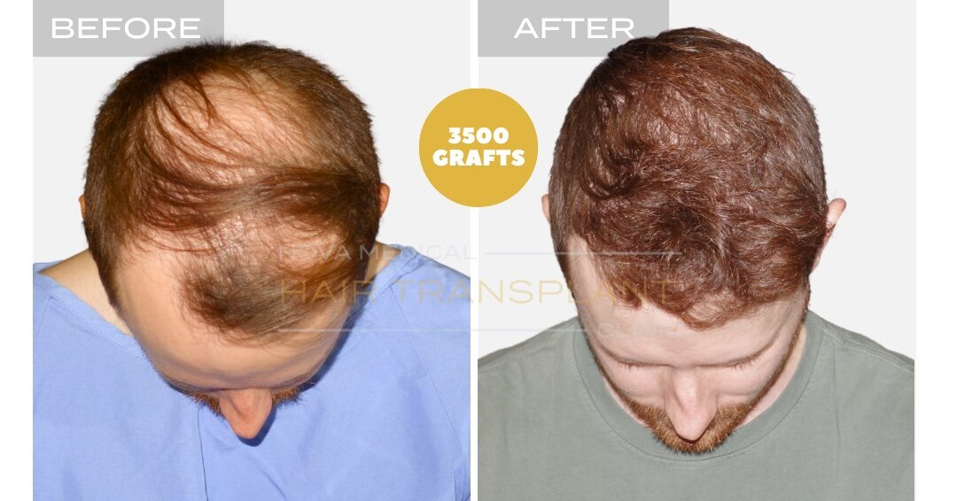 Hair Transplant Before & After Result 2 - HAIRLINE FORMATION + CROWN DENSITY RESTORATION. MICRO FUE 3500 GRAFTS., Nova Medical