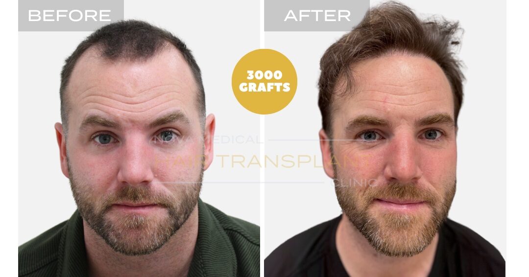 Hair Transplant Before & After Result 4 - HAIRLINE RESTORATION + DENSITY FILLING. MANUAL FUE 3000 GRAFTS., Nova Medical