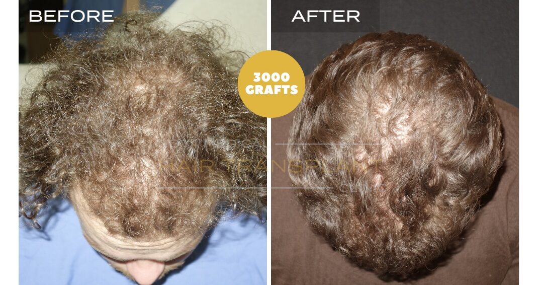 Hair Transplant Before & After Result 6 - FOR CURLY HAIR. DENSITY FILLING. SHAVELESS MANUAL FUE 3000 GRAFTS, Nova Medical