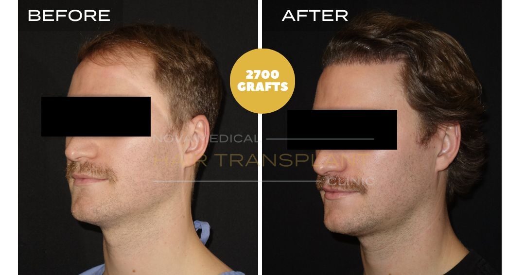 Hair Transplant Before & After Result 7 - HAIRLINE + DENSITY RESTORATION. MANUAL FUE 2700 GRAFTS., Nova Medical