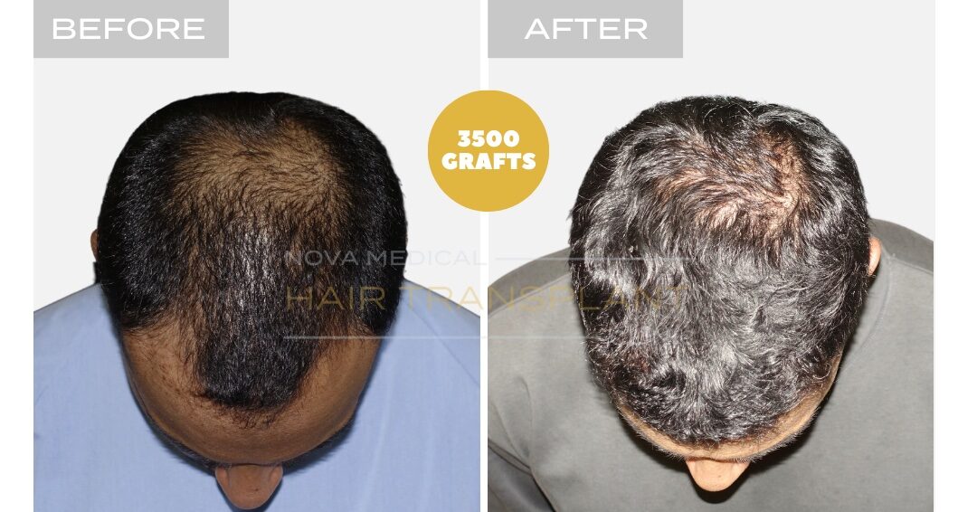 Hair Transplant Before & After Result 10 - THICK HAIR HAIRLINE RESTORATION. MANUAL FUE 3500 GRAFTS., Nova Medical