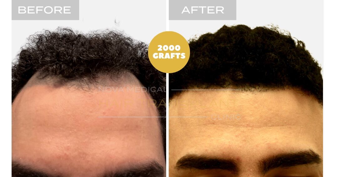 Hair Transplant Before & After Result 13 - HAIRLINE RESTORATION + DENSITY FILLING. MANUAL FUE 3000 GRAFTS., Nova Medical