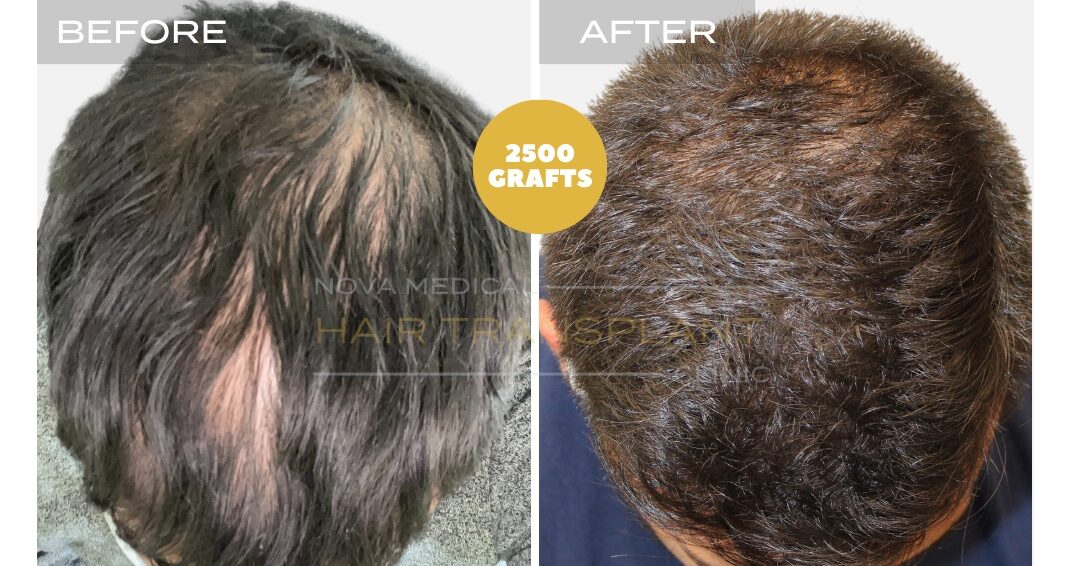 Hair Transplant Before & After Result 15 - HAIRLINE + CROWN DENSITTY RESTORATION. MANUAL FUE 3000 GRAFTS., Nova Medical