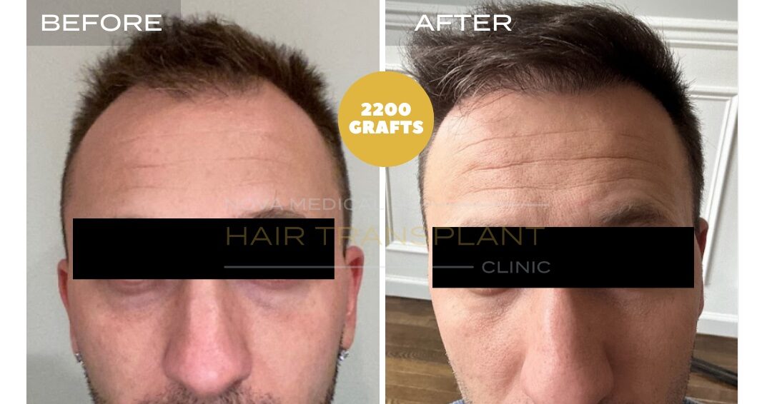 Hair Transplant Before & After Result 17 - HAIRLINE + CROWN DENSITY FILLING. MANUAL FUE 2200 GRAFTS., Nova Medical