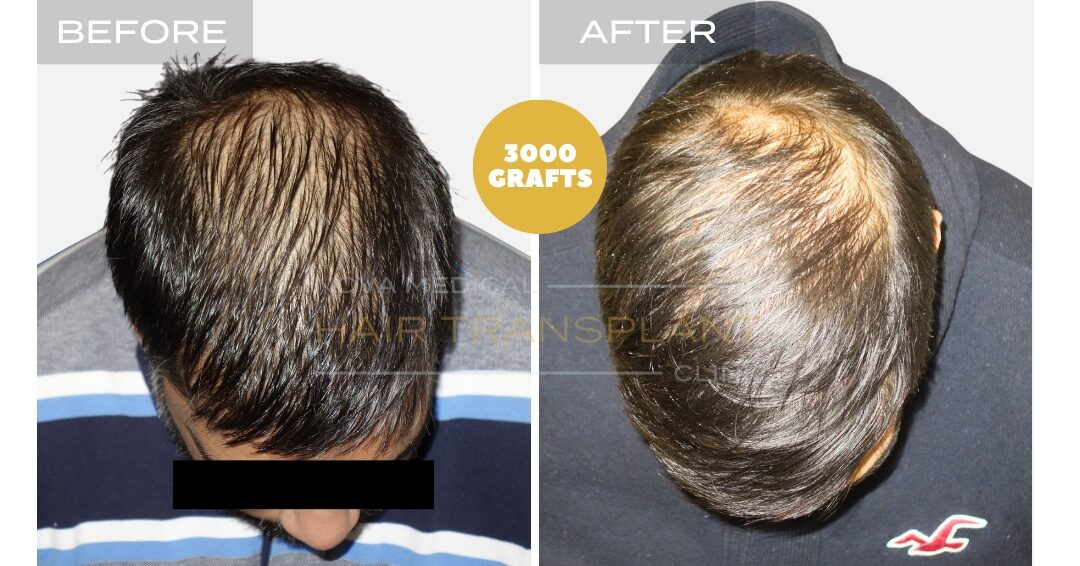 Hair Transplant Before & After Result 27 - HAIRLINE + DENSITY RESTORATION. MANUAL FUE 3000 GRAFTS., Nova Medical