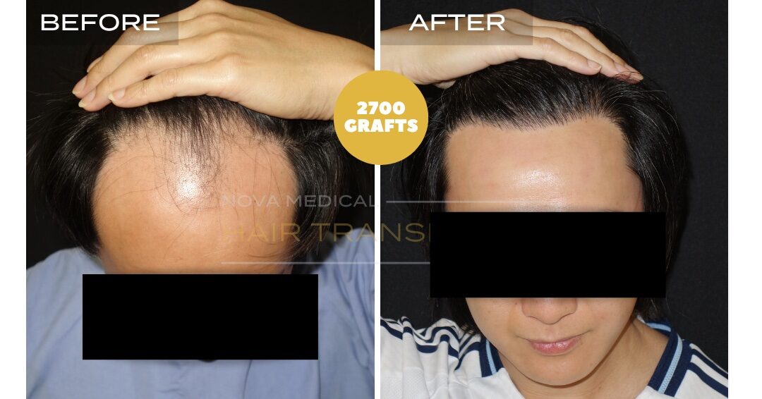 Hair Transplant Before & After Result 29 - HAIRLINE RESTORATION. MANUAL FUE 2700 GRAFTS., Nova Medical