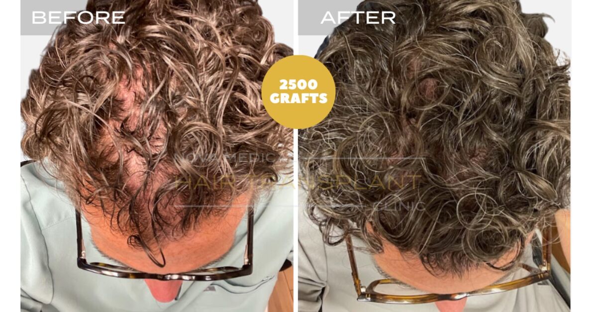 Hair Transplant Video Case Study 1 - SHAVELESS MANUAL FUE 2500 GRAFTS FOR CURLY HAIR. DENSITY FILLING., Nova Medical