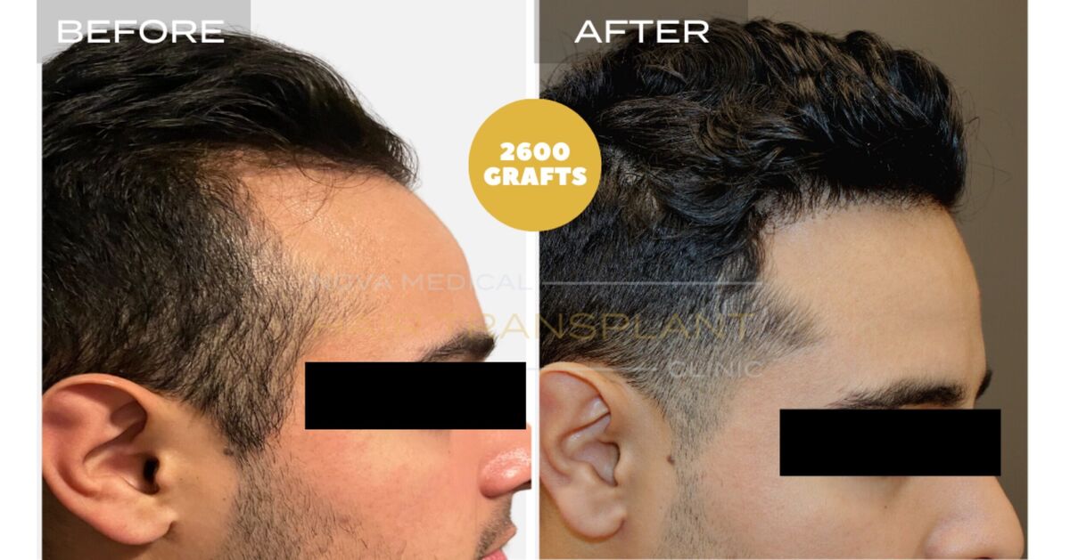 Hair Transplant Video Case Study 6 - TEMPLE FILLING + HAIRLINE RESTORATION. MANUAL FUE 2600 GRAFTS., Nova Medical