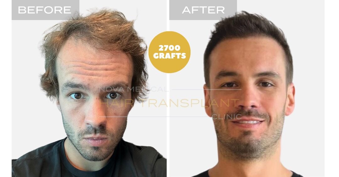 Hairline and density restoration, manual FUE 2700 grafts - Nova Medical Philadelphia