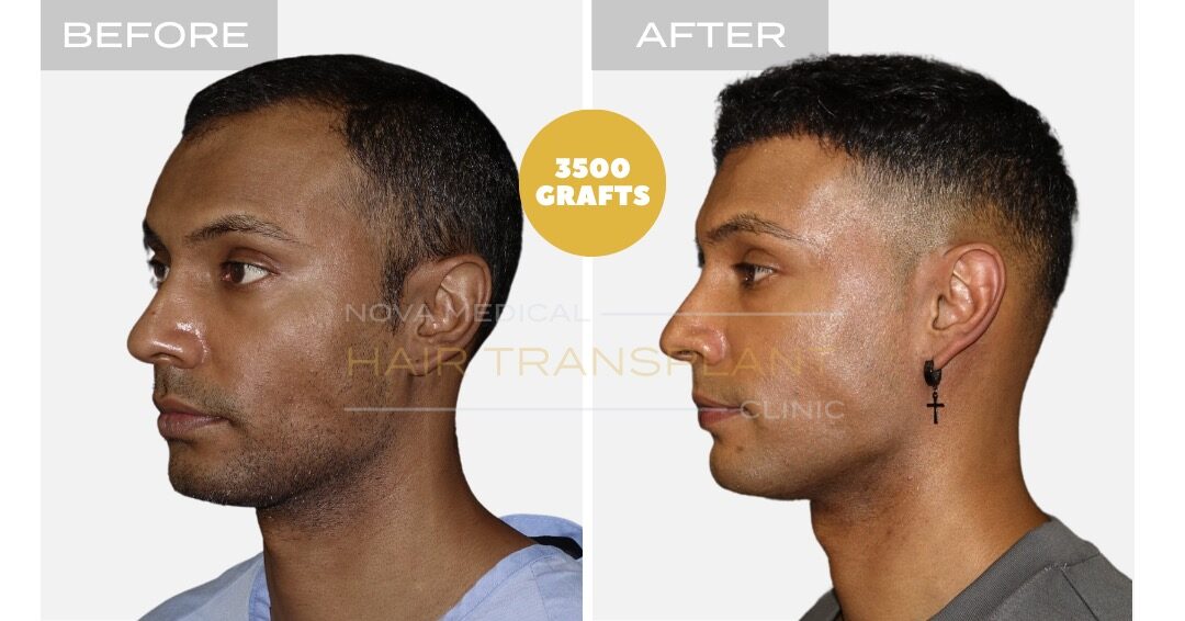 Thick hair hairline restoration, manual FUE 3500 grafts - Nova Medical Philadelphia