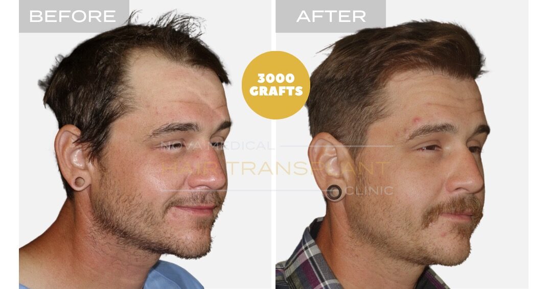 High density hairline restoration, manual FUE 3000 grafts - Nova Medical Philadelphia