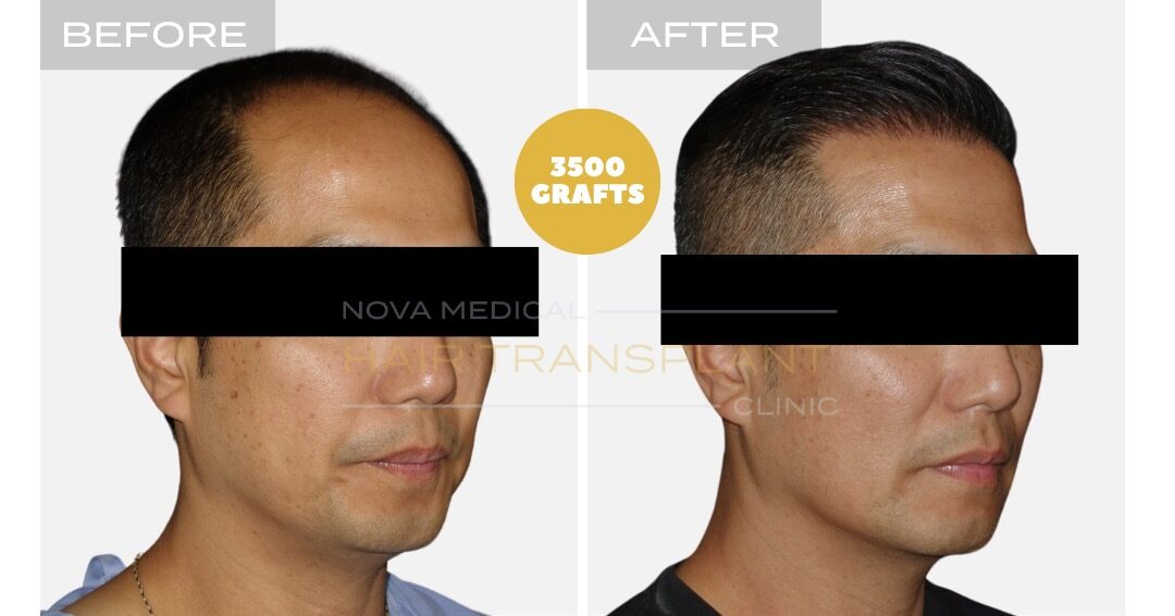 High density hairline restoration, Asian hair manual FUE 3500 grafts - Nova Medical Philadelphia